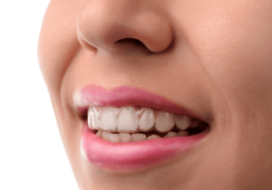 Exploring Dental Implants CA
